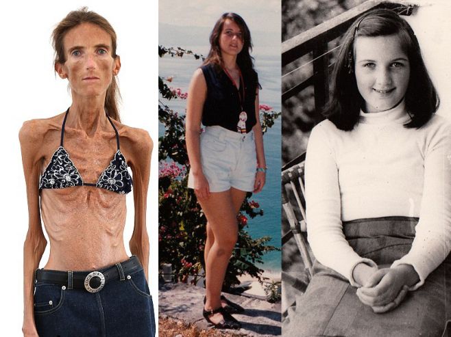 ▷ Imágenes de la mujer más flaca del mundo